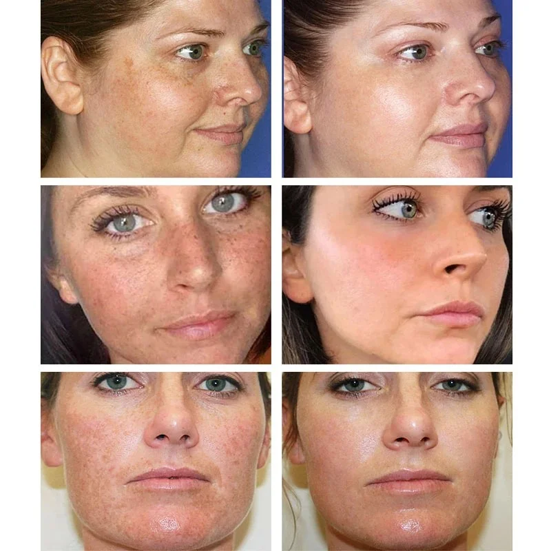 Effective Whitening Freckles C - đánh giá và giá Licorice Root Sticks